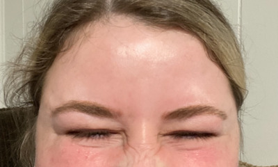 After treatment - Botox for Frown Lines