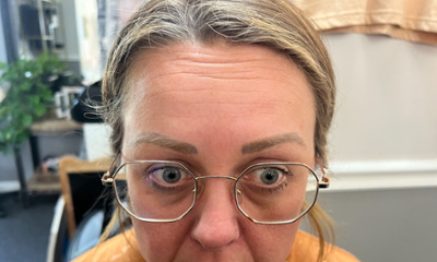 After treatment - Facial Botox Esthetics