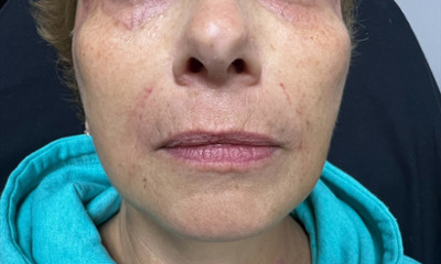 After treatment - Facial Esthetics