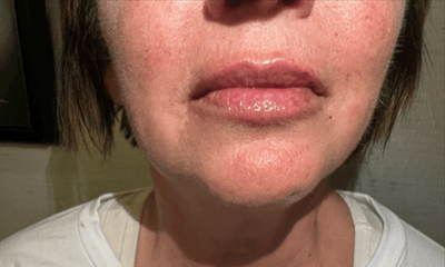 After treatment - Facial Esthetics