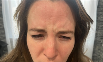 After treatment - Facial Esthetics