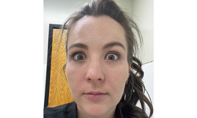 After treatment - Facial Esthetics