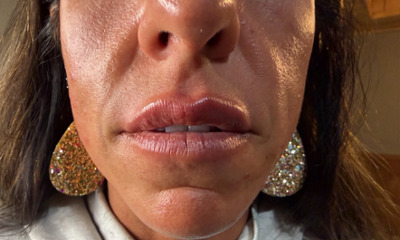 After treatment - Lip Enhancement