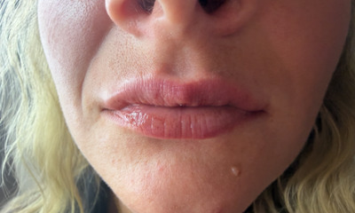 After treatment - Lip Enhancement