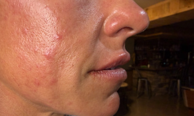 After treatment - Upper Lip Enhancement