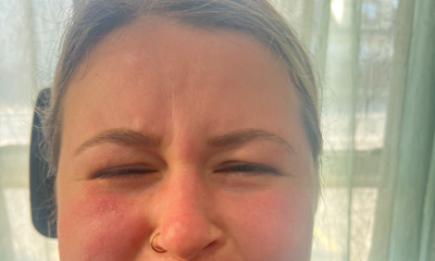Before treatment - Botox for Frown Lines