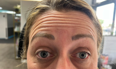 Before treatment - Facial Botox Esthetics