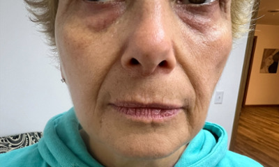 Before treatment - Facial Esthetics