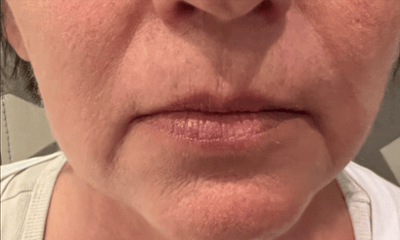 Before treatment - Facial Esthetics
