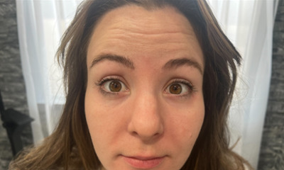 Before treatment - Facial Esthetics