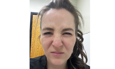 Before treatment - Facial Esthetics