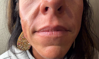 Before treatment - Lip Enhancement