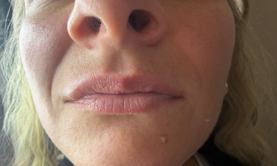 Before treatment - Lip Enhancement