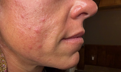 Before treatment - Upper Lip Enhancement